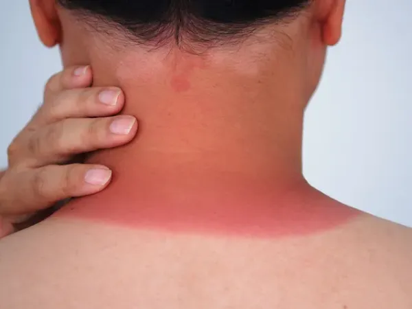 Sonnenbrand - Verbraucherinformation der DKV
