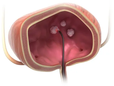 Diagnose Blasentumor: Frauen zunehmend betroffen - Schonende Entfernung mit neuer TULA-Lasertherapie