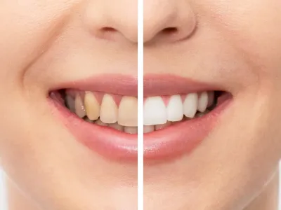 Bleaching Hamburg Professionelles Zahnbleaching vs. Hausmittel: Ein detaillierter Vergleich durch Zahnärzte aus Hamburg Wandsbek